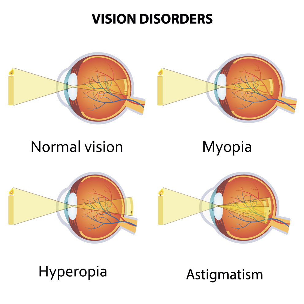 Conditions Implantable Contact Lens Can Treat