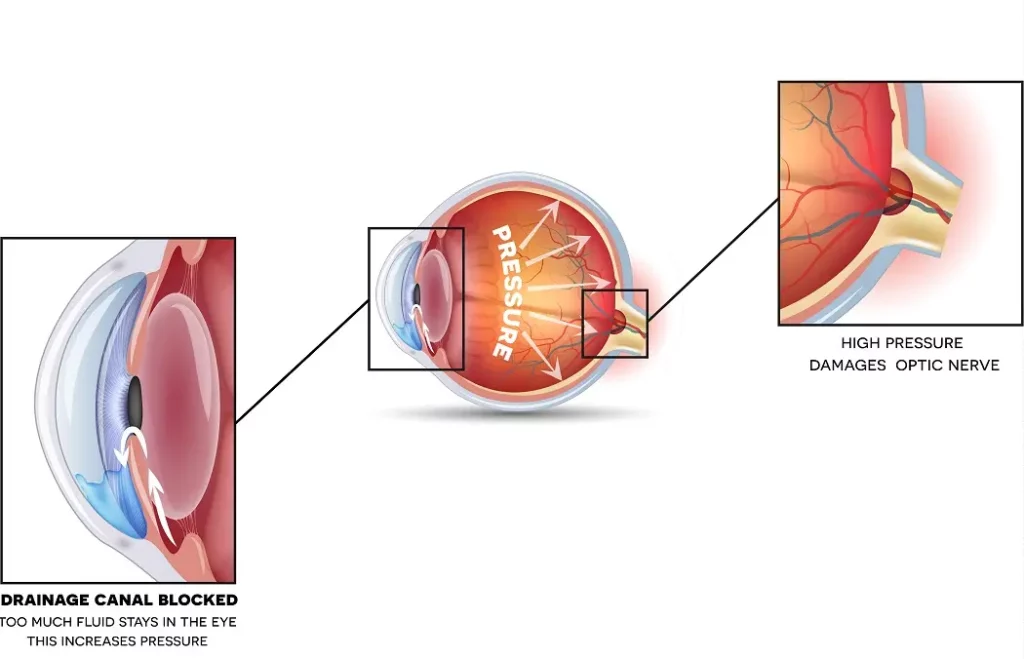 Glaucoma