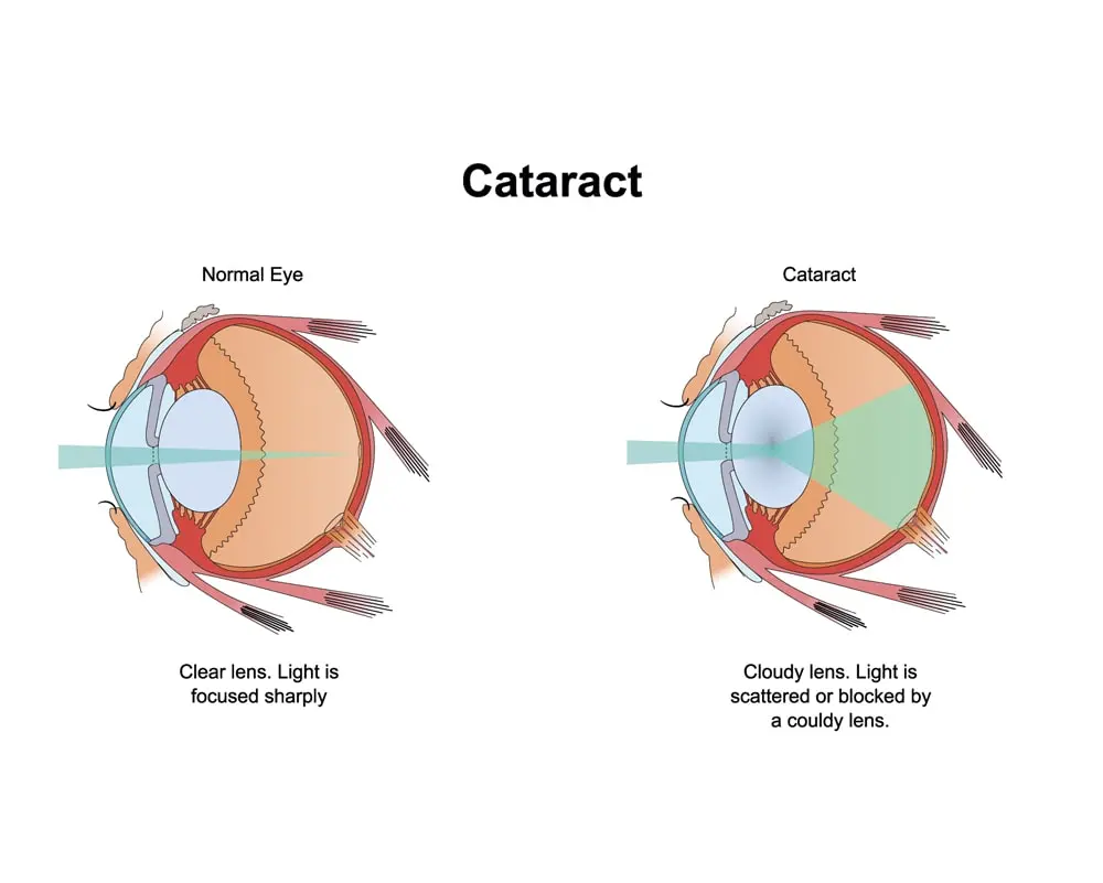 How Do Toric Lens Implants Help With Cataracts?