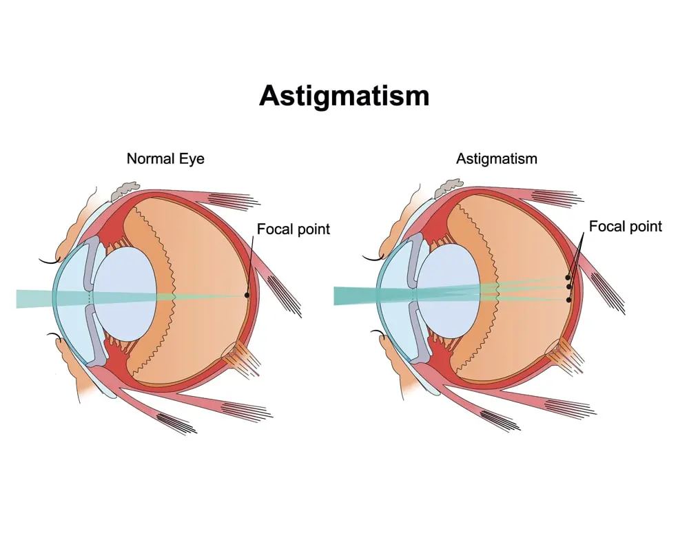 How Does a Toric Lens Work With Astigmatism?