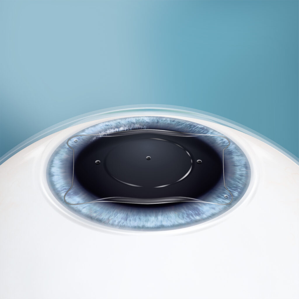 Implantable Collamer Lense
