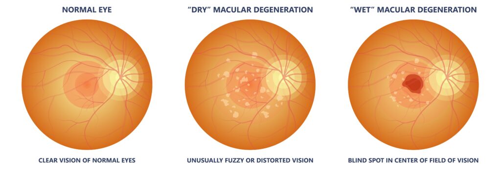 what does macular degeneration look like