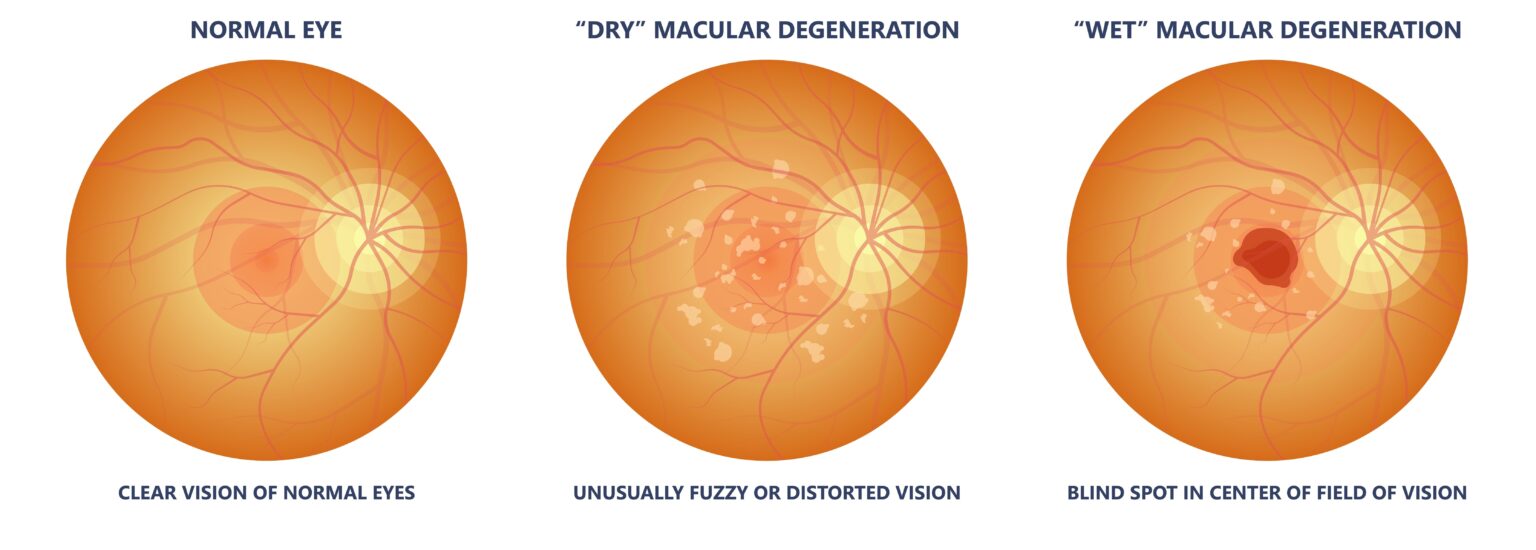 Macular Degeneration Treatment in Kansas City, MO Discover Vision