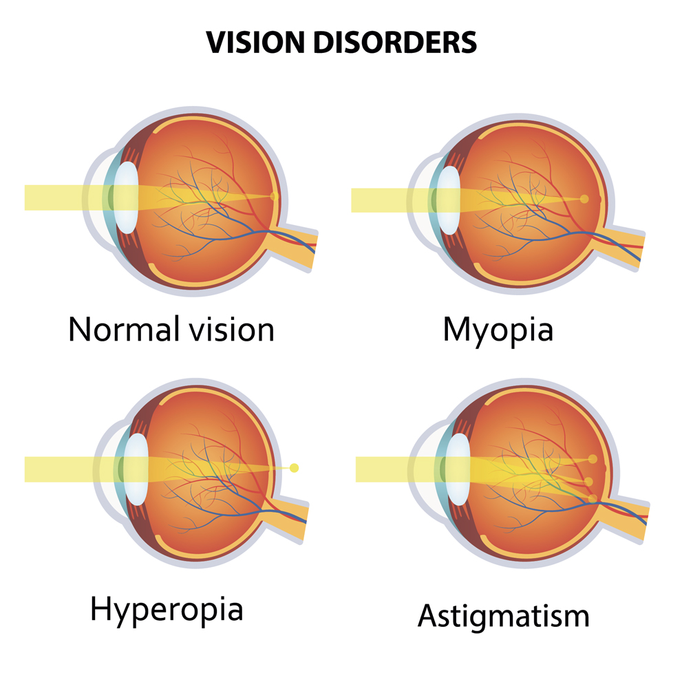 Types of PRK Procedures We Provide