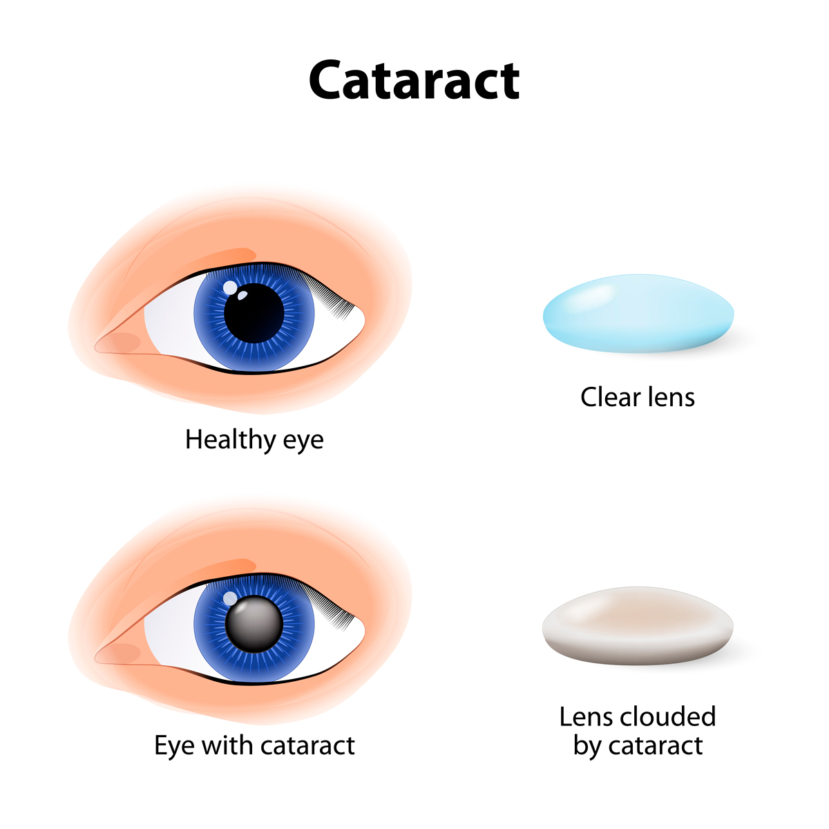 What Are Cataracts?