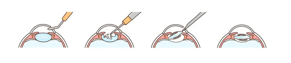 What Happens During the Toric IOL Surgery