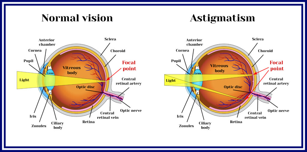 What Is Astigmatism?