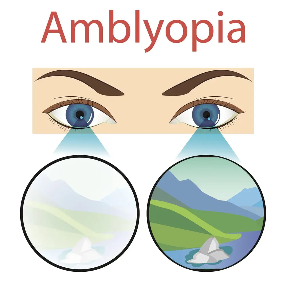 What Is a Lazy Eye (Amblyopia)?