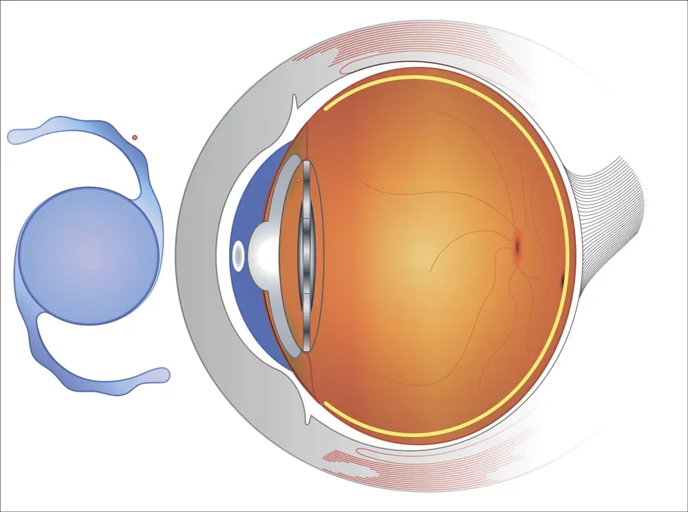 What Is a Toric IOL Lens Implant?