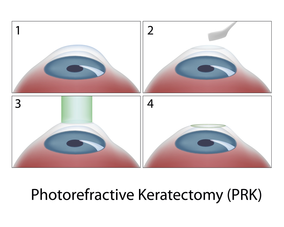 What to Expect During PRK & ASA Procedure?