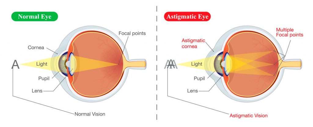 astigmatism vs normal vision