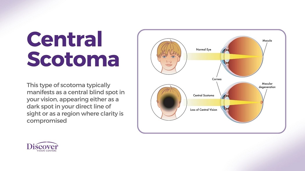 Scotoma Blind Spot in Vision Discover Vision