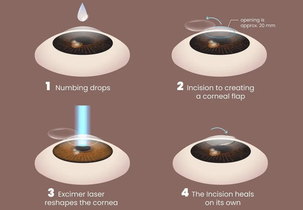 complications of smile eye surgery