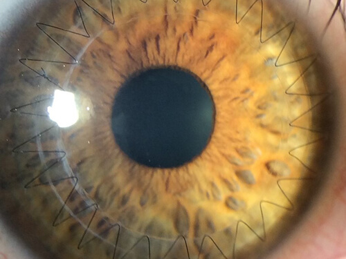 Eye That Has Had a Corneal Transplant