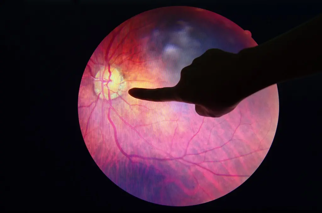 diabetic cataract
