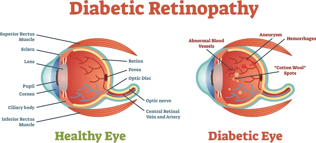diabetic eye problems