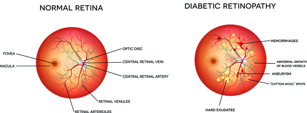 Chart Illustrating a Normal Retina Compared to One With Diabetic Retinopathy