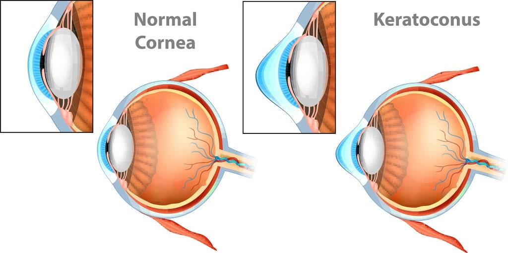does keratoconus cause blindness