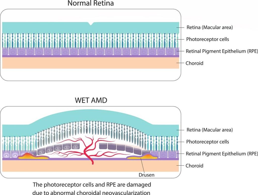 dry macular degeneration vs wet