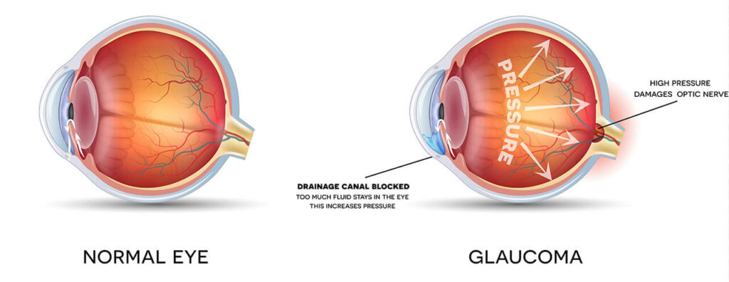 Chart Illustrating a Healthy Eye Vs One With Glaucoma