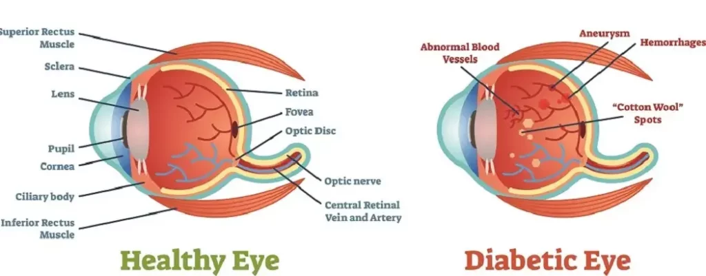 How Does Diabetes Affect My Eyes?