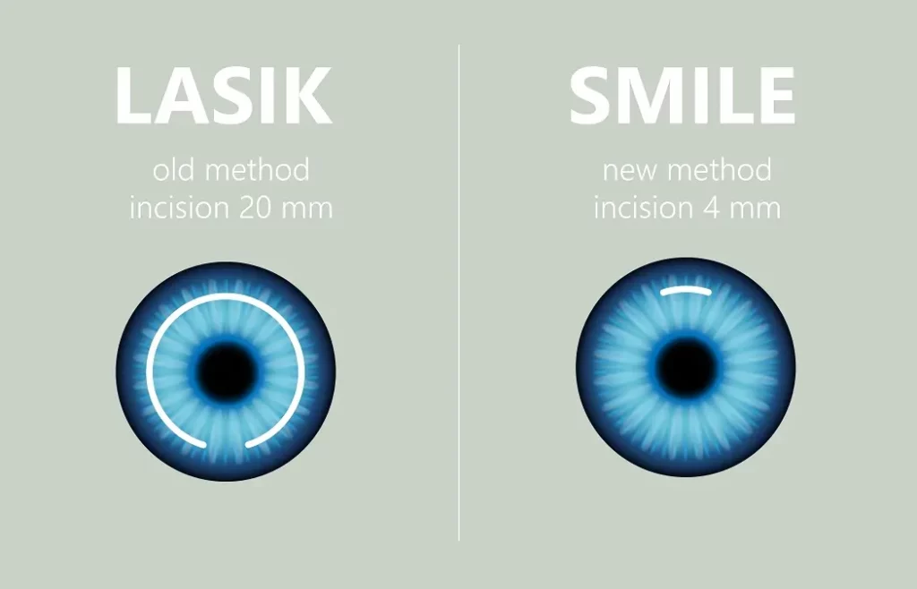 how safe is smile eye surgery