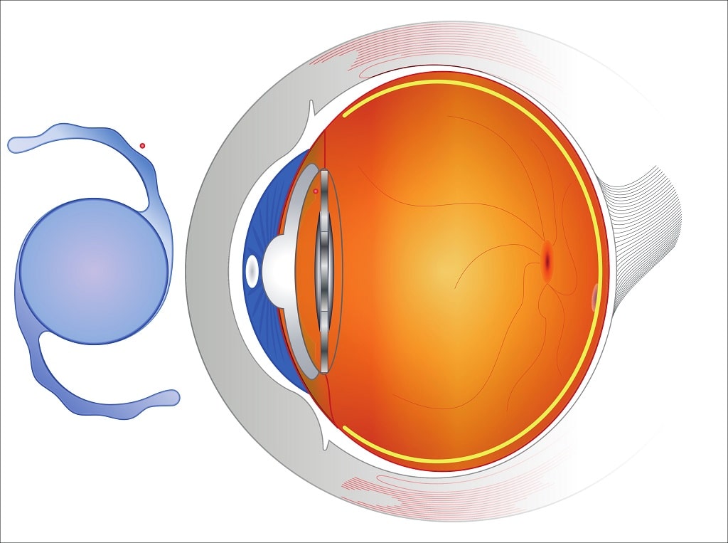 implantable collamer lens