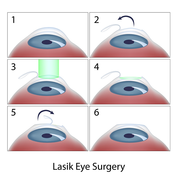 LASIK Surgery Chart