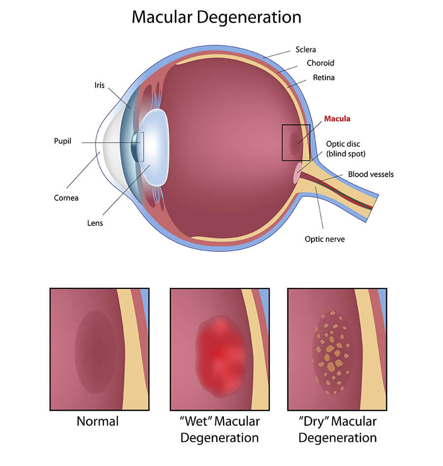Chart Showing How Macular Degeneration Affects the Eye