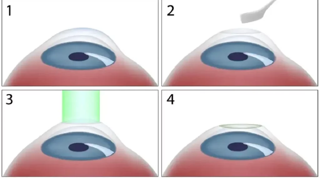 Monovision PRK (Photorefractive Keratectomy)