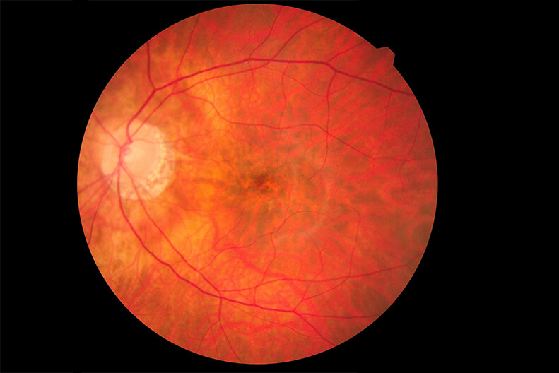 Retinal Scan