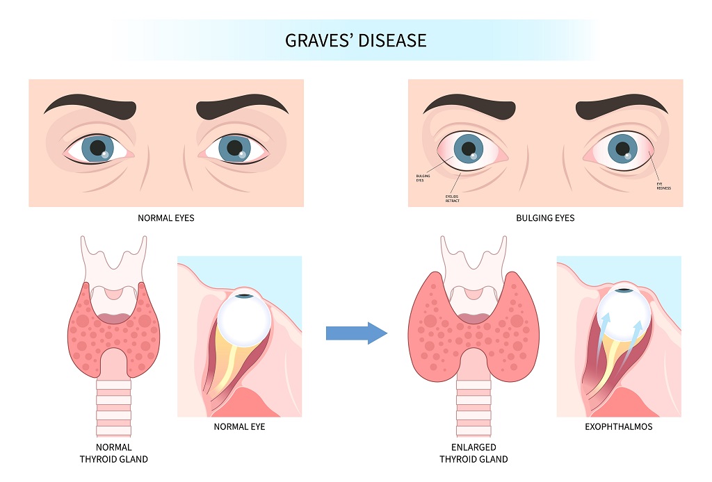 What Causes Thyroid Eye Disease