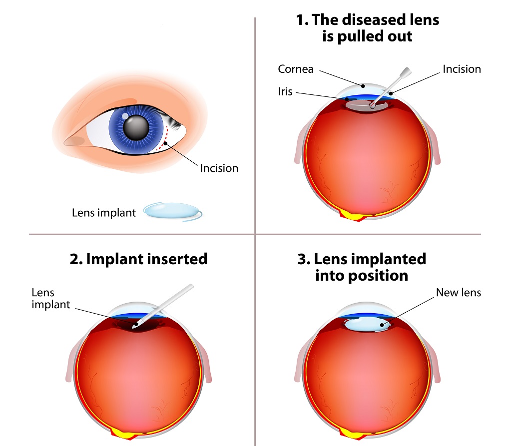 intraocular lens implantation