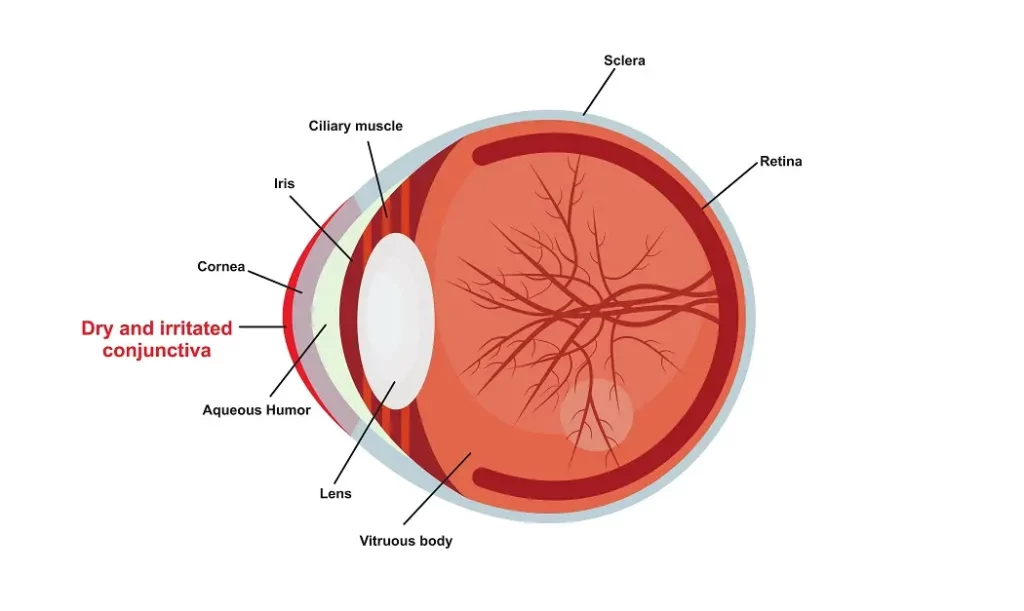 Understanding Dry Eye