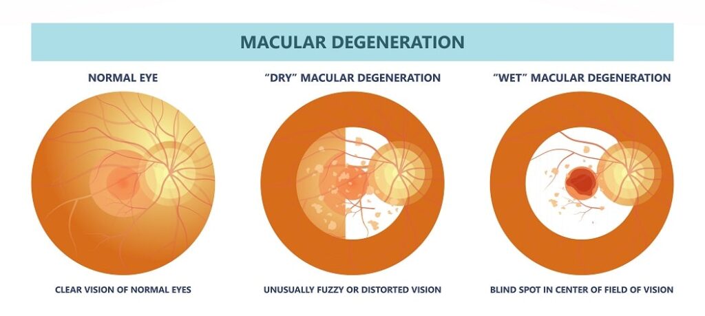 wet vs dry macular degeneration treatment