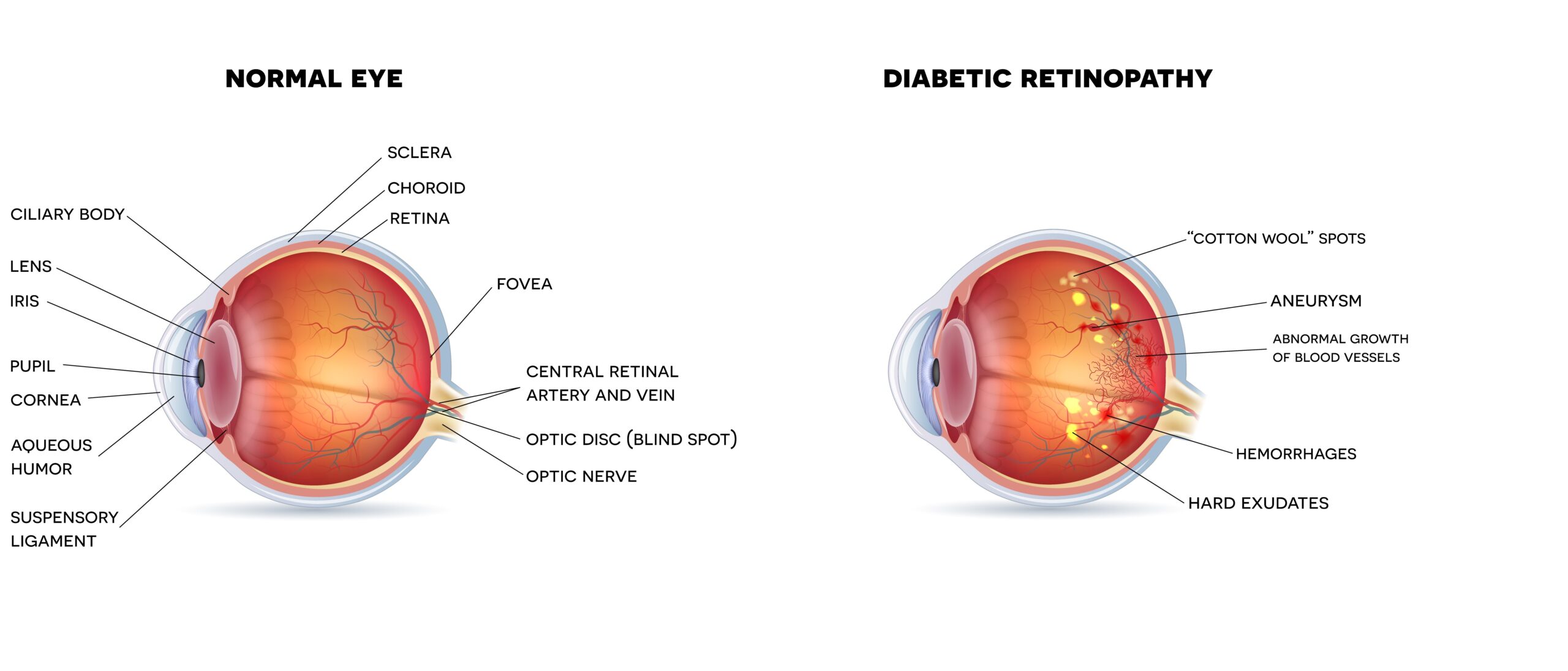 what does diabetic retinopathy look like