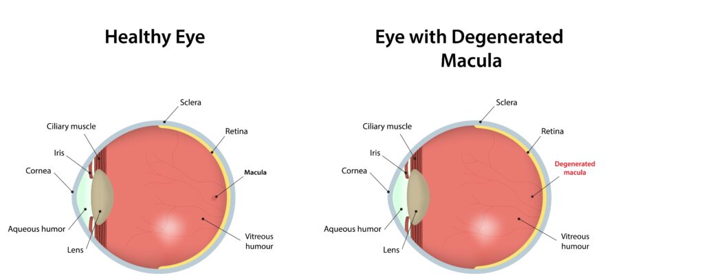 what does macular degeneration look like