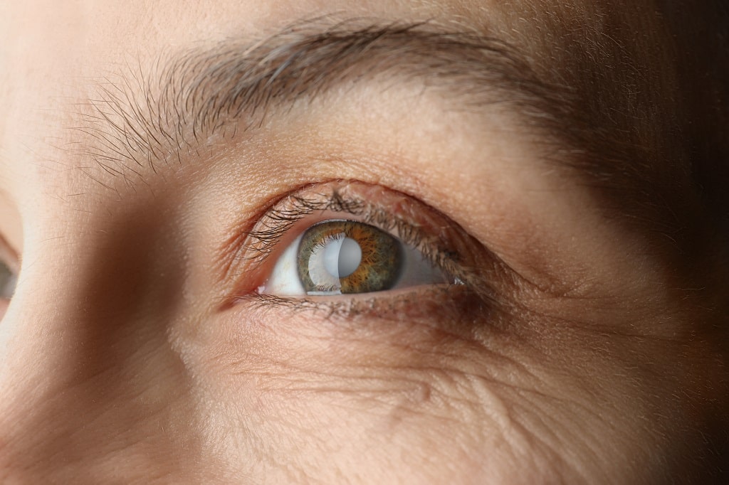 what is a cataract